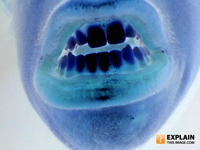 Black_teeth